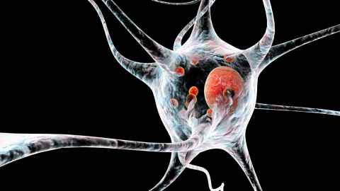Neurone affected by Parkinson's disease.