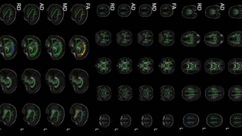 MRI scan of baby brains