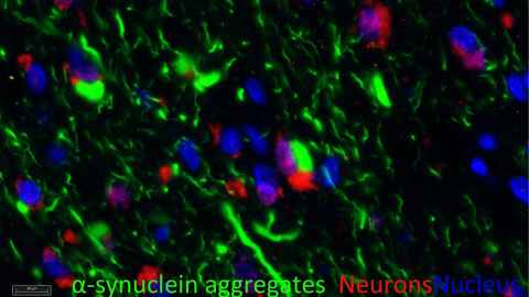 Alpha synuclein, a protein that researchers can now detect abnormal clumping of 