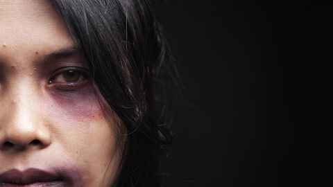 Close up of bruised face of woman